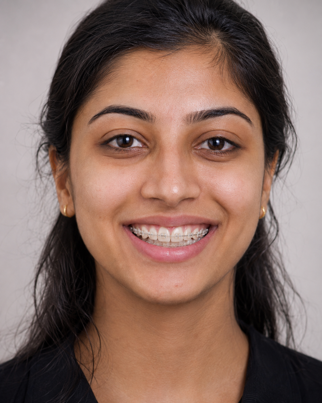 After ceramic braces - same young woman smiling confidently with ceramic braces and aligned teeth