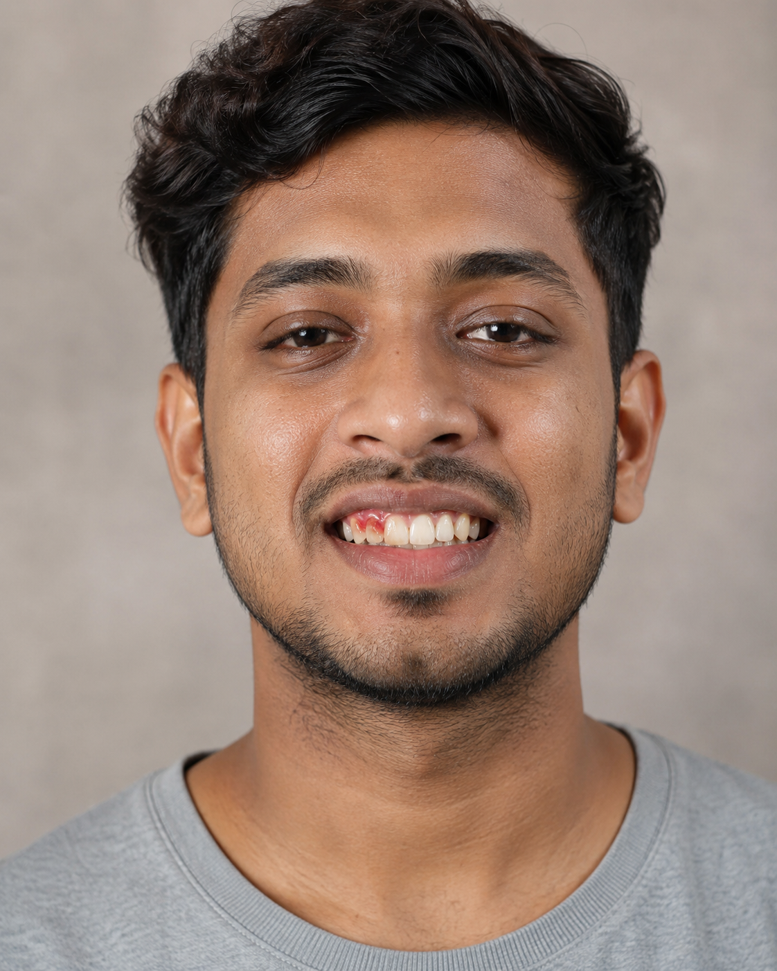 Before gum treatment - young man smiling showing inflamed swollen gums and yellowish teeth