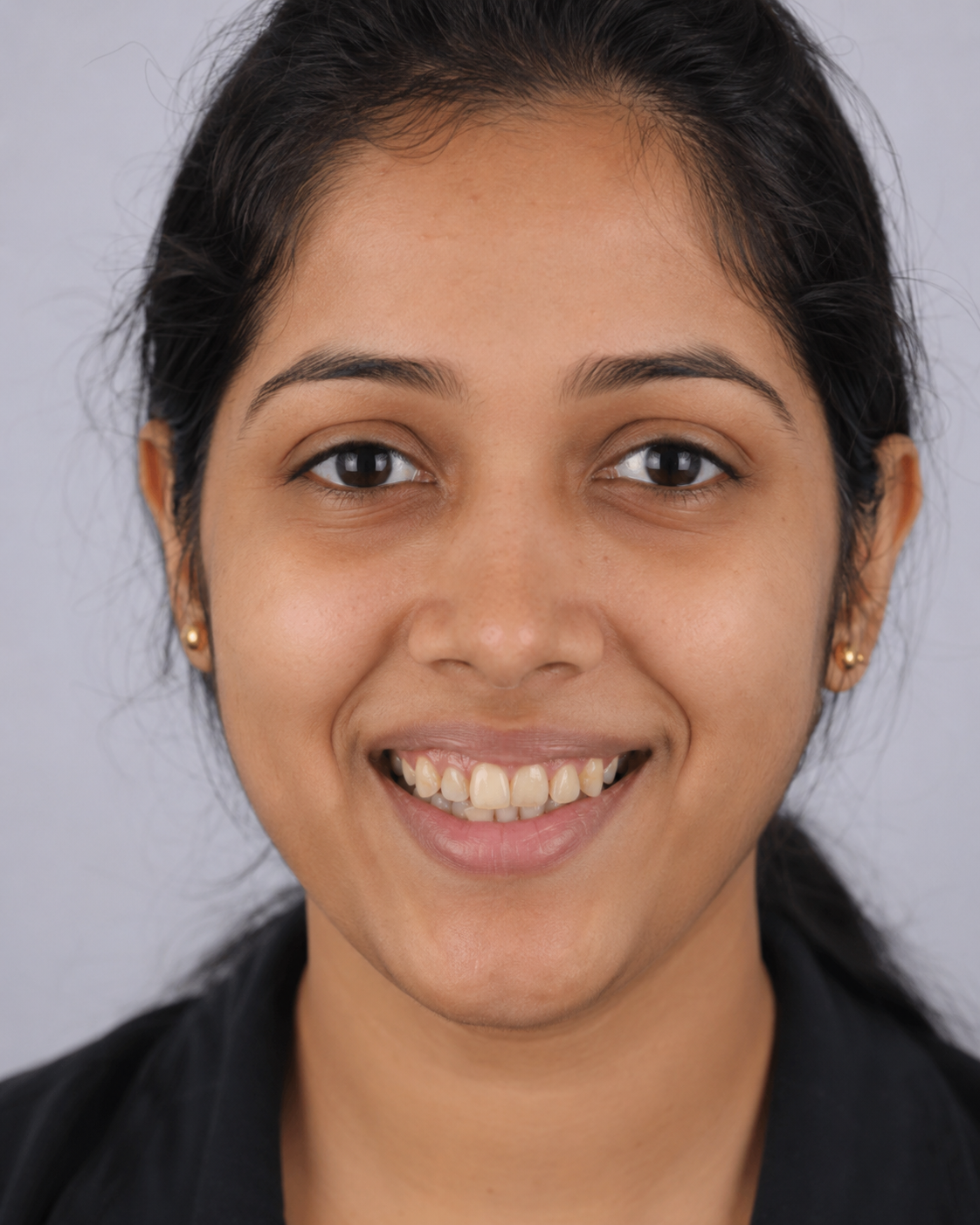 Before smile design and whitening - patient smiling showing teeth before treatment