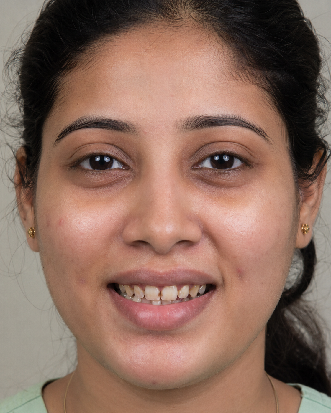 Before porcelain veneer smile makeover - patient smiling showing teeth