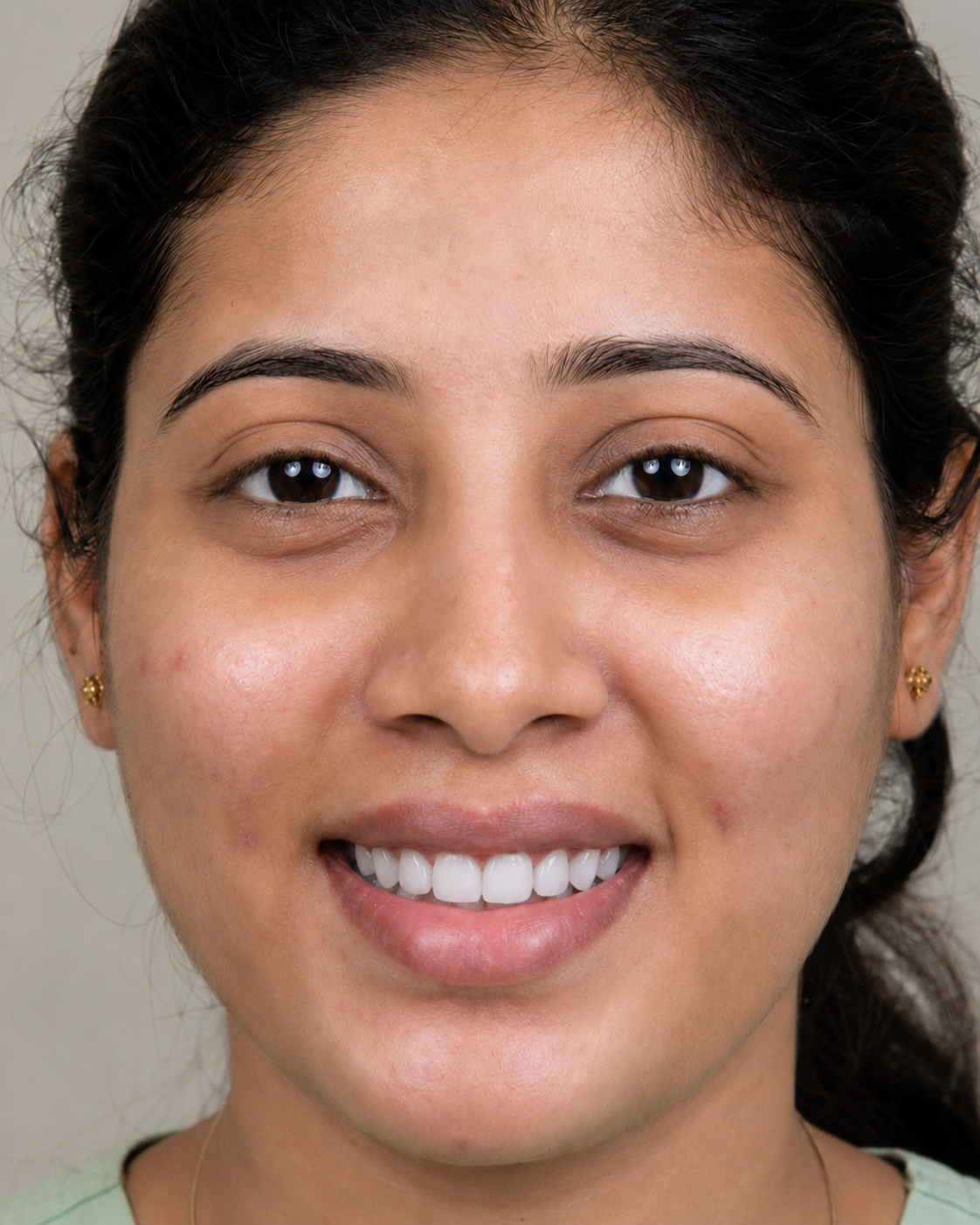 After porcelain veneer smile makeover - patient smiling showing transformed smile