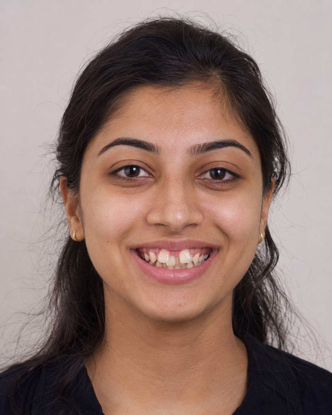 Before ceramic braces - young woman smiling with misaligned teeth before orthodontic treatment