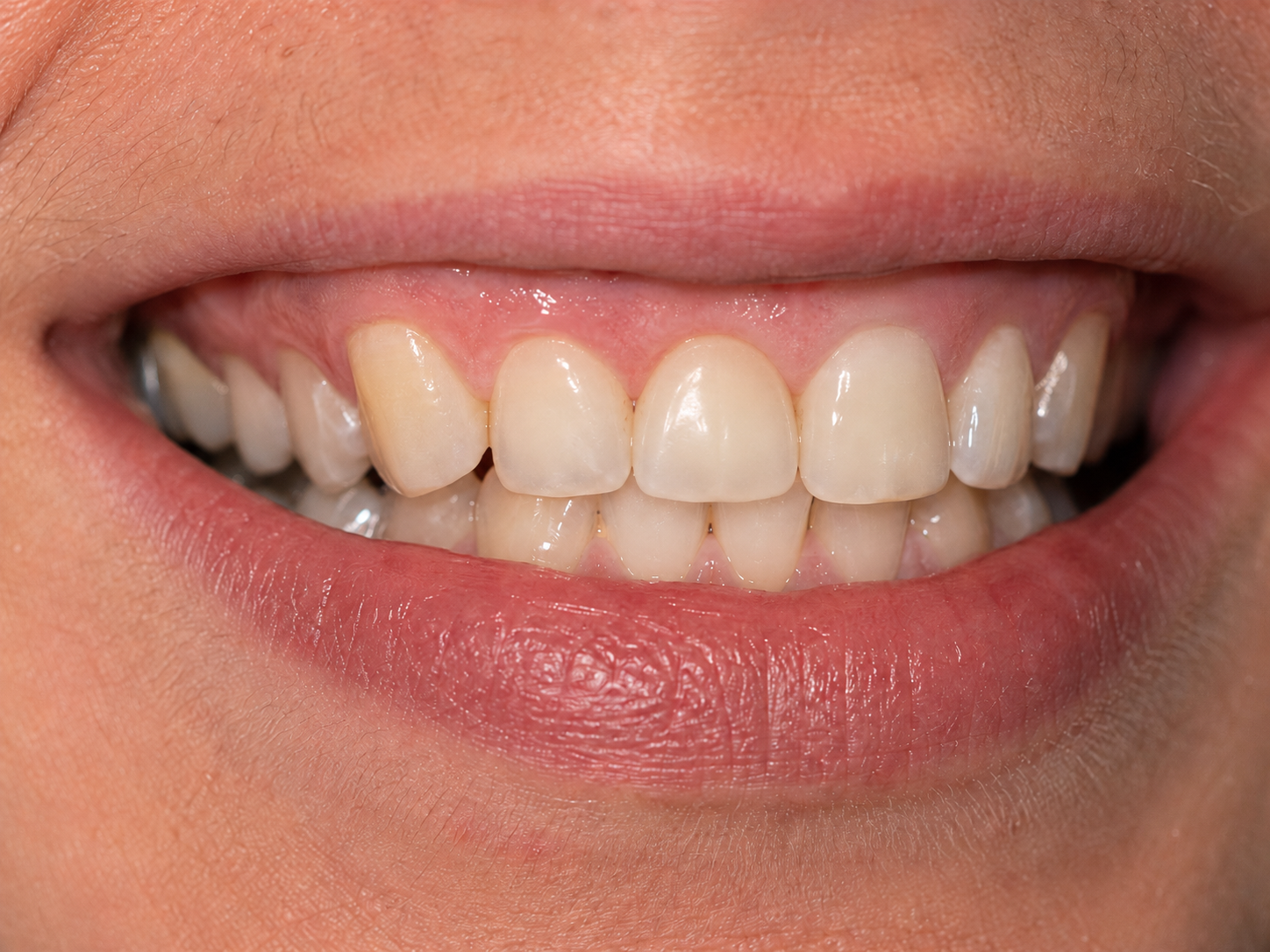 After treatment - full tooth restored with dental implant