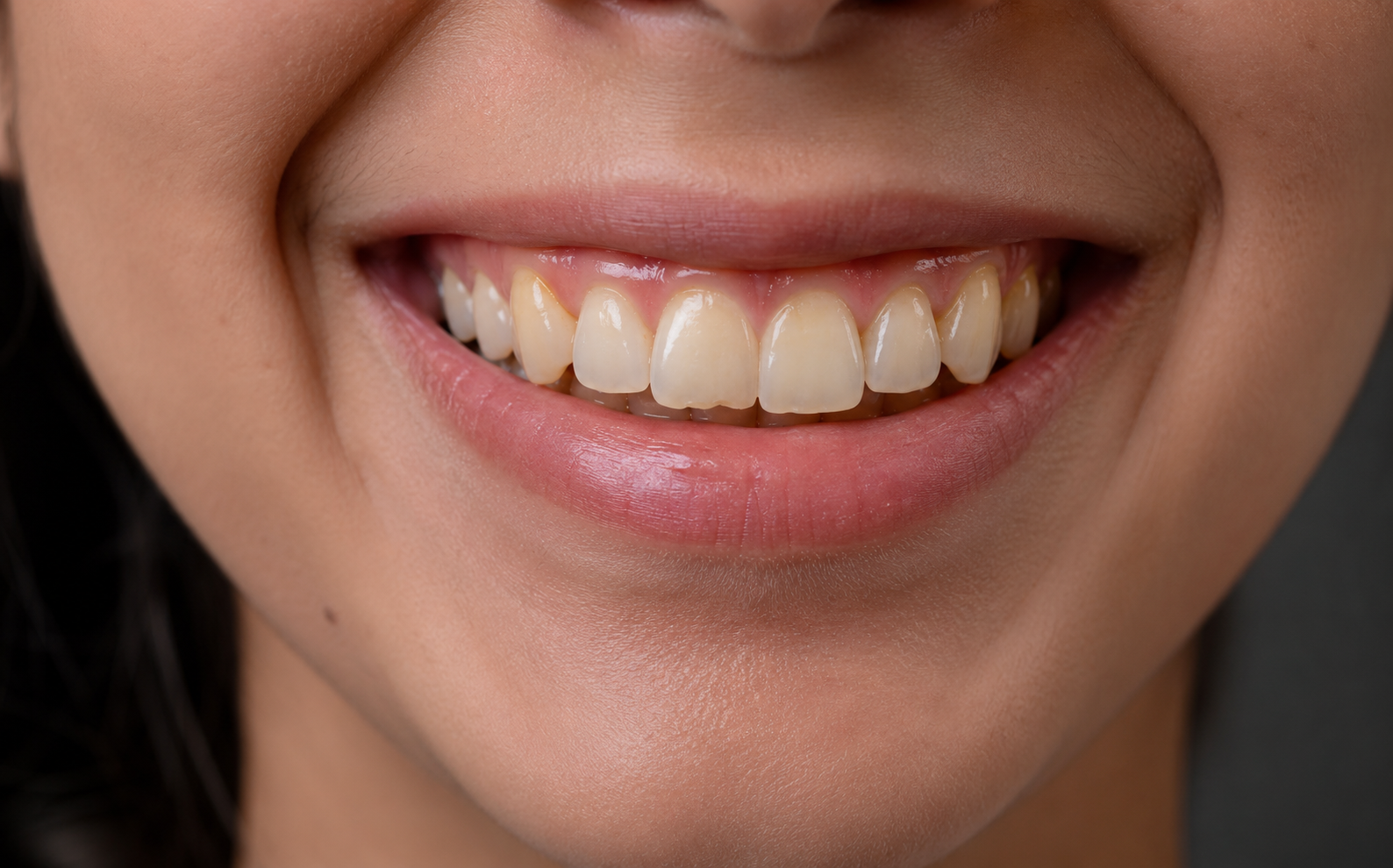 Before whitening and bonding treatment — yellow discolored teeth